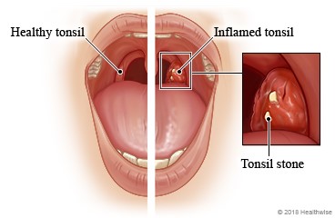 tonsils stones